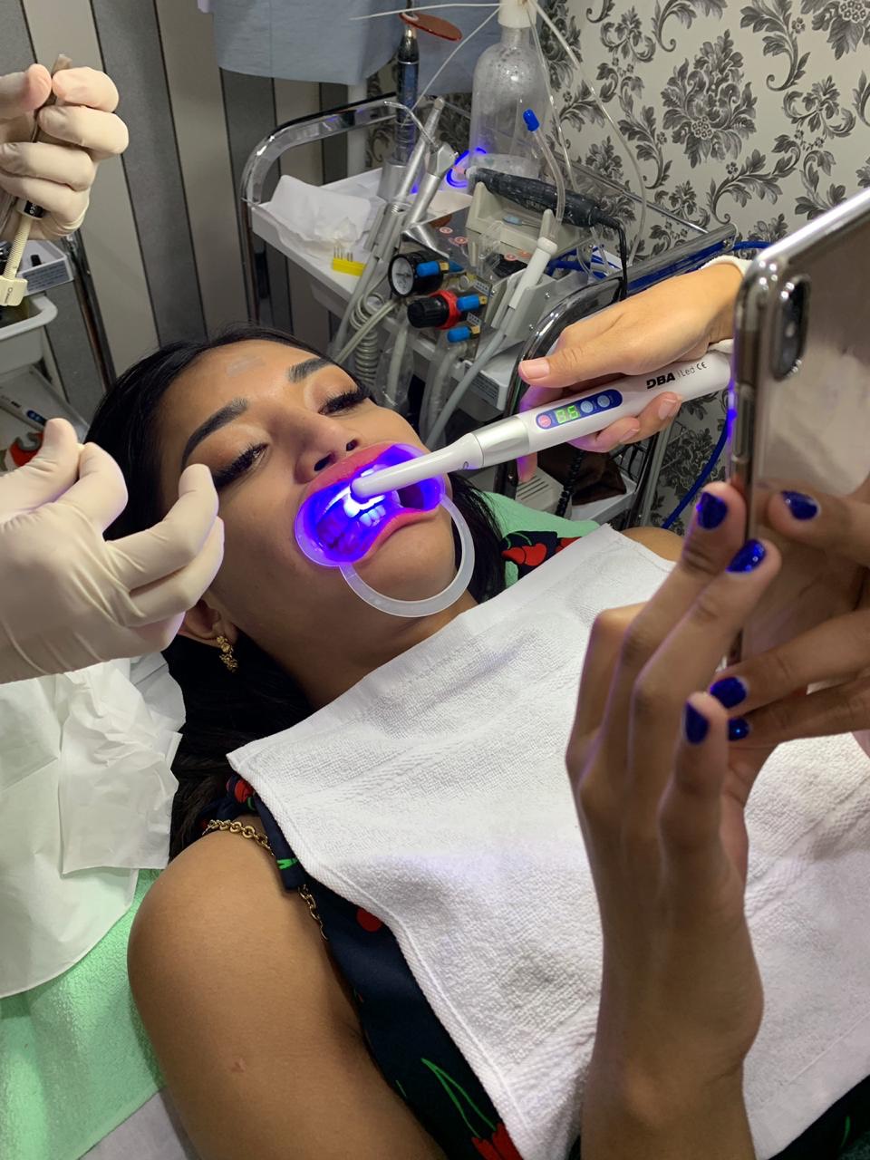 Veneer Gigi 